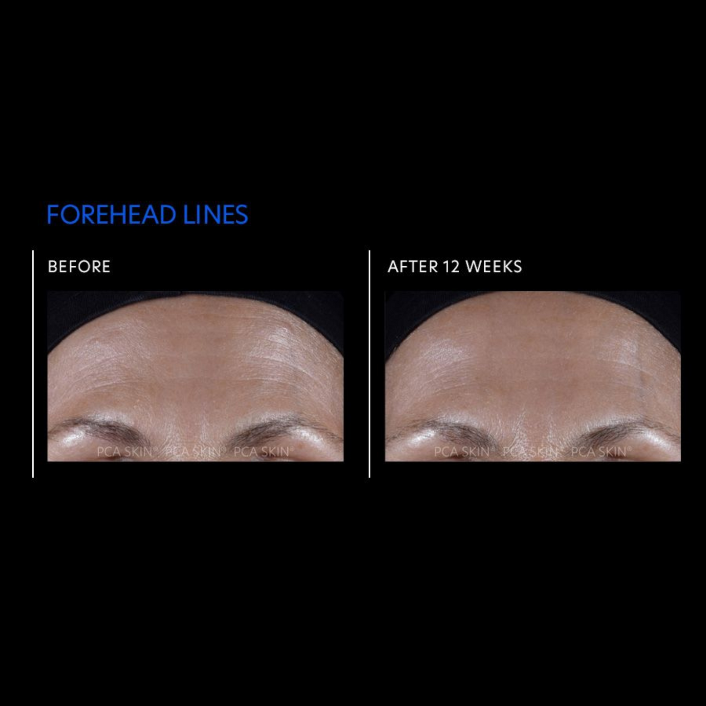 ExLinea® Pro Peptide Serum | PCA Skin