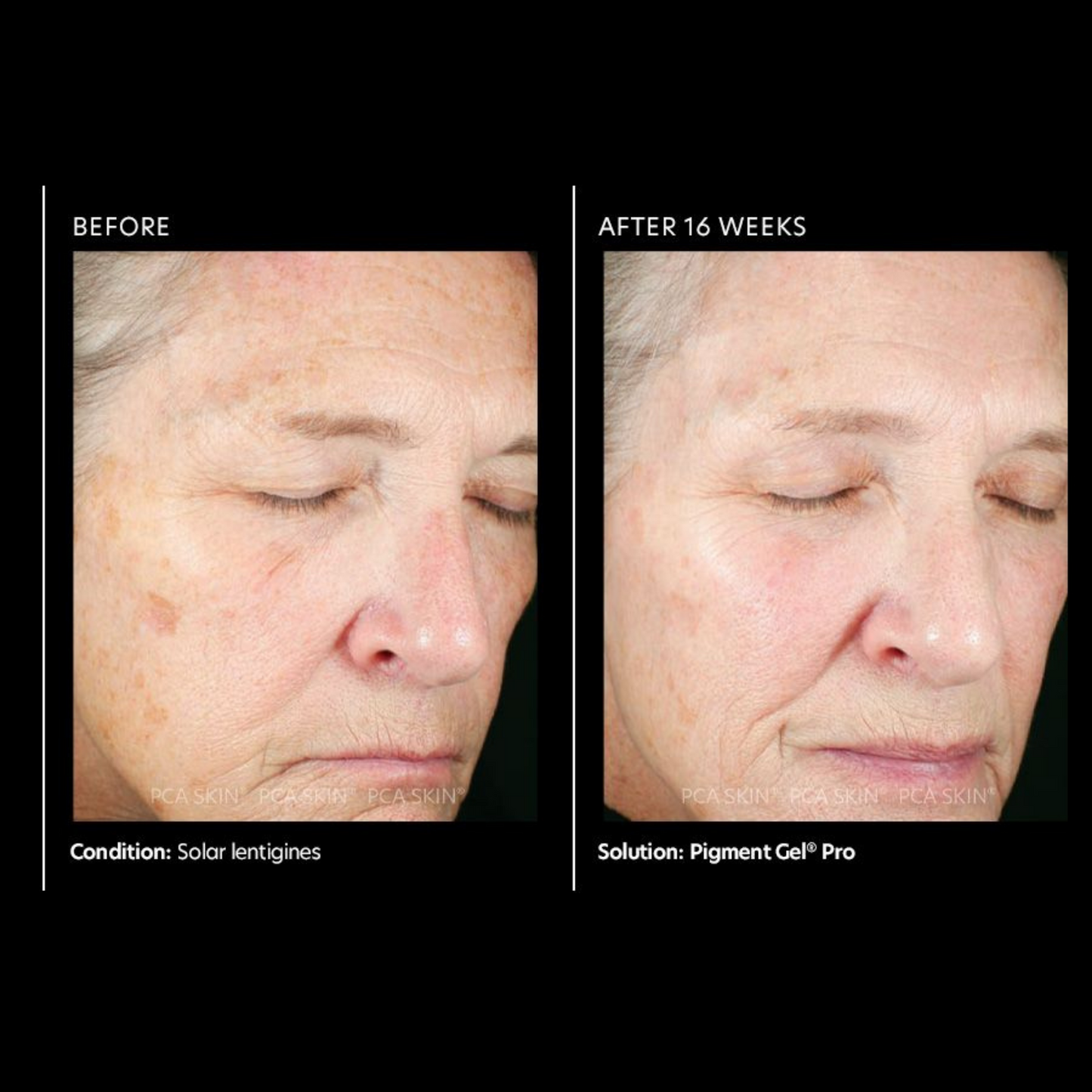 Pigment Gel® Pro | PCA Skin