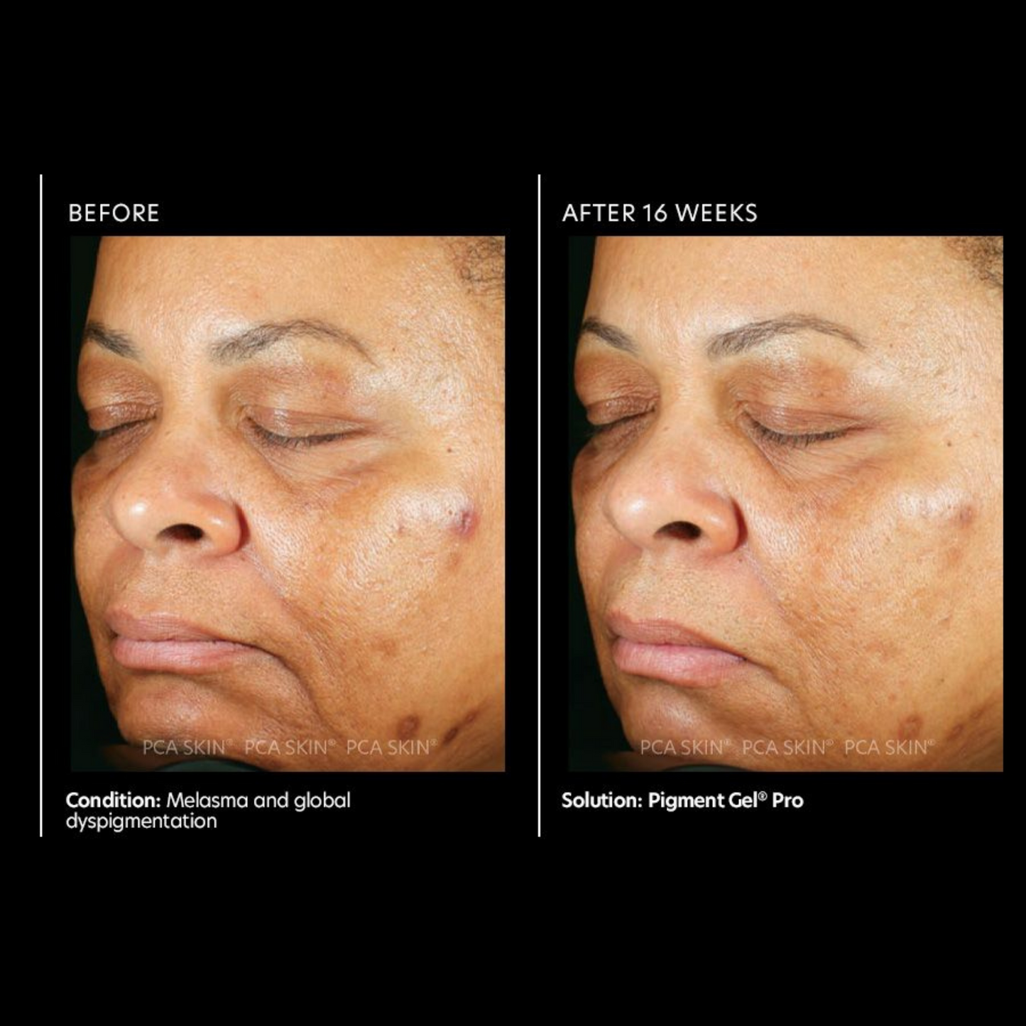 Pigment Gel® Pro | PCA Skin