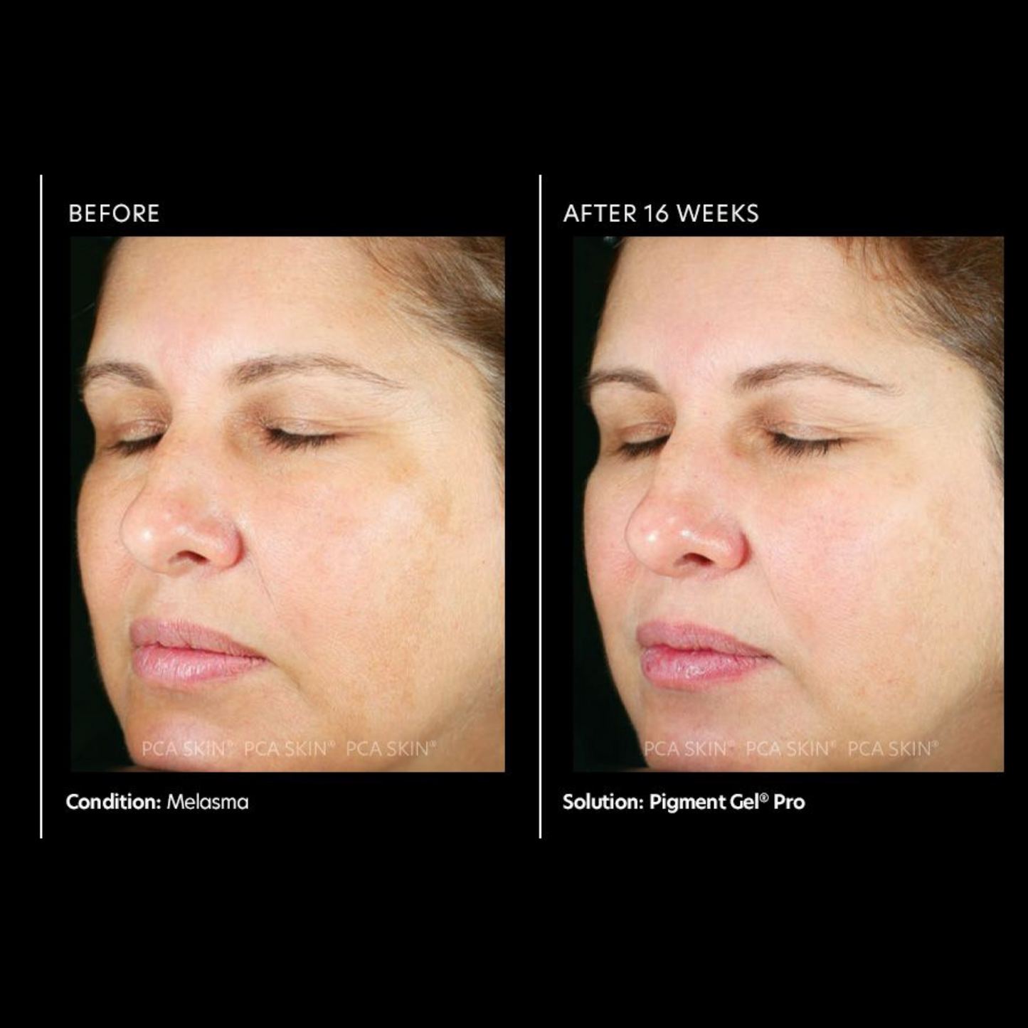 Pigment Gel® Pro | PCA Skin