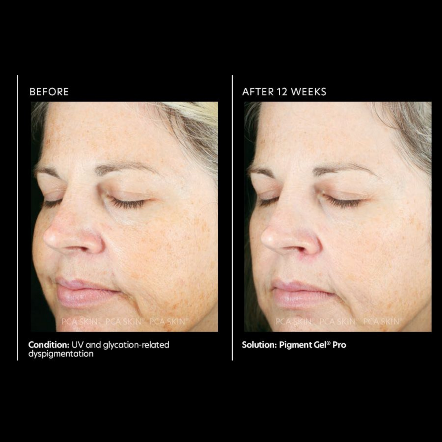 Pigment Gel® Pro | PCA Skin