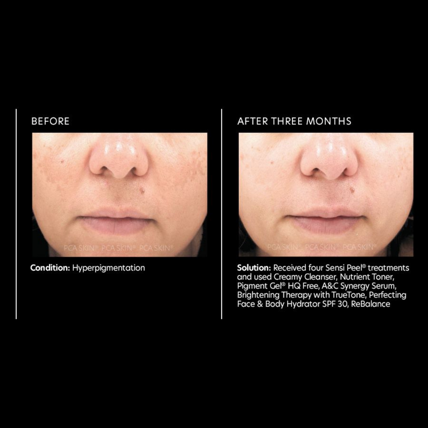 Pigment Gel® HQ Free | PCA Skin